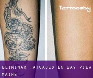 Eliminar tatuajes en Bay View (Maine)