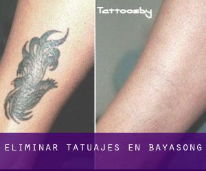 Eliminar tatuajes en Bayasong