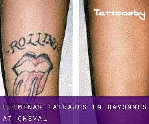Eliminar tatuajes en Bayonnes at Cheval