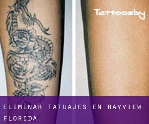 Eliminar tatuajes en Bayview (Florida)