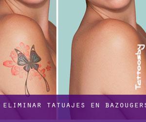 Eliminar tatuajes en Bazougers