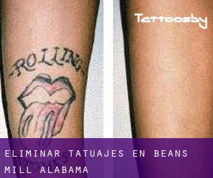 Eliminar tatuajes en Beans Mill (Alabama)