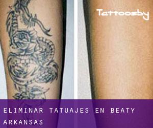 Eliminar tatuajes en Beaty (Arkansas)