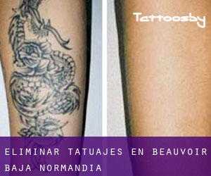 Eliminar tatuajes en Beauvoir (Baja Normandía)