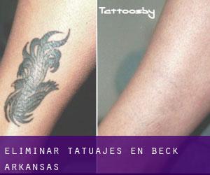 Eliminar tatuajes en Beck (Arkansas)