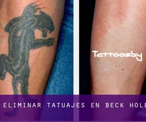 Eliminar tatuajes en Beck Hole