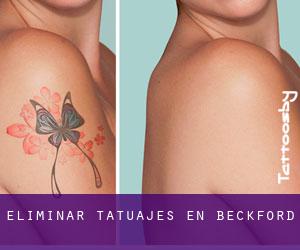 Eliminar tatuajes en Beckford