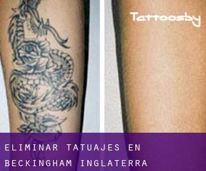 Eliminar tatuajes en Beckingham (Inglaterra)