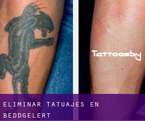Eliminar tatuajes en Beddgelert