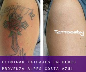 Eliminar tatuajes en Bèdes (Provenza-Alpes-Costa Azul)