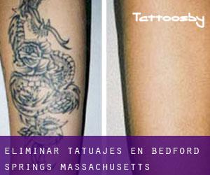 Eliminar tatuajes en Bedford Springs (Massachusetts)