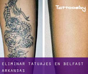 Eliminar tatuajes en Belfast (Arkansas)