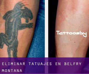 Eliminar tatuajes en Belfry (Montana)