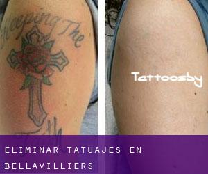 Eliminar tatuajes en Bellavilliers