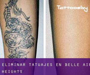 Eliminar tatuajes en Belle Air Heights