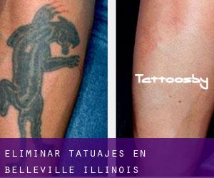 Eliminar tatuajes en Belleville (Illinois)