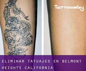 Eliminar tatuajes en Belmont Heights (California)