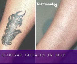 Eliminar tatuajes en Belp