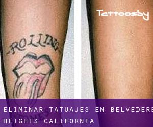 Eliminar tatuajes en Belvedere Heights (California)