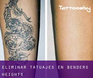 Eliminar tatuajes en Benders Heights