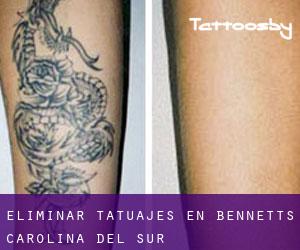 Eliminar tatuajes en Bennetts (Carolina del Sur)