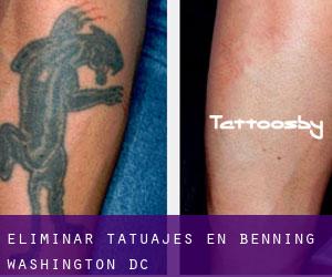 Eliminar tatuajes en Benning (Washington, D.C.)