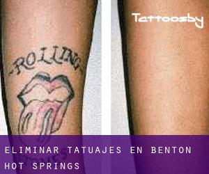 Eliminar tatuajes en Benton Hot Springs