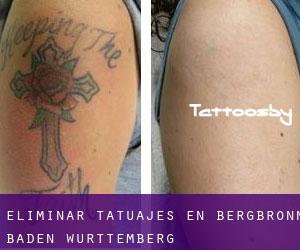 Eliminar tatuajes en Bergbronn (Baden-Württemberg)