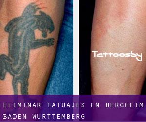 Eliminar tatuajes en Bergheim (Baden-Württemberg)