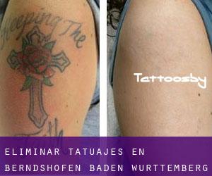 Eliminar tatuajes en Berndshofen (Baden-Württemberg)