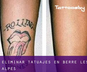 Eliminar tatuajes en Berre-les-Alpes