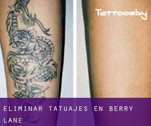 Eliminar tatuajes en Berry Lane