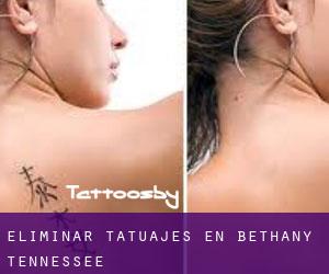 Eliminar tatuajes en Bethany (Tennessee)
