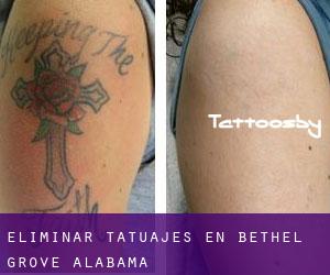Eliminar tatuajes en Bethel Grove (Alabama)
