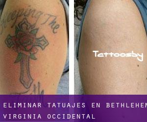 Eliminar tatuajes en Bethlehem (Virginia Occidental)