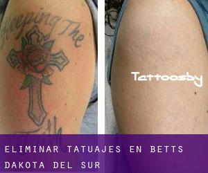 Eliminar tatuajes en Betts (Dakota del Sur)