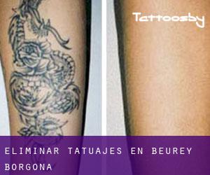 Eliminar tatuajes en Beurey (Borgoña)