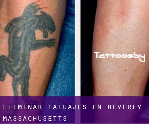 Eliminar tatuajes en Beverly (Massachusetts)