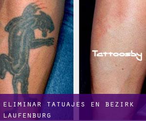 Eliminar tatuajes en Bezirk Laufenburg