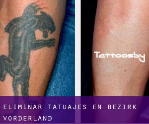 Eliminar tatuajes en Bezirk Vorderland