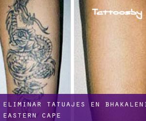 Eliminar tatuajes en Bhakaleni (Eastern Cape)