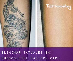 Eliminar tatuajes en Bhongolethu (Eastern Cape)