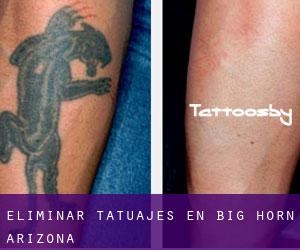 Eliminar tatuajes en Big Horn (Arizona)