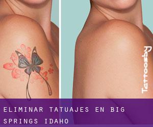 Eliminar tatuajes en Big Springs (Idaho)
