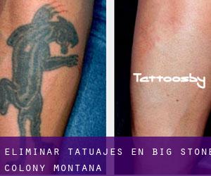 Eliminar tatuajes en Big Stone Colony (Montana)