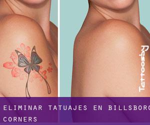 Eliminar tatuajes en Billsboro Corners