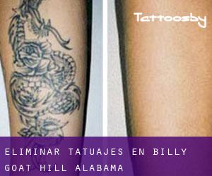 Eliminar tatuajes en Billy Goat Hill (Alabama)