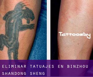 Eliminar tatuajes en Binzhou (Shandong Sheng)