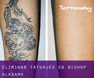 Eliminar tatuajes en Bishop (Alabama)