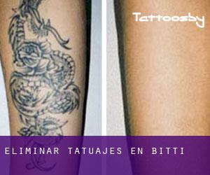Eliminar tatuajes en Bitti